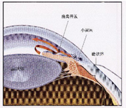 開角型青光眼