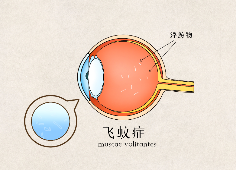 老年人眼睛飛蚊癥